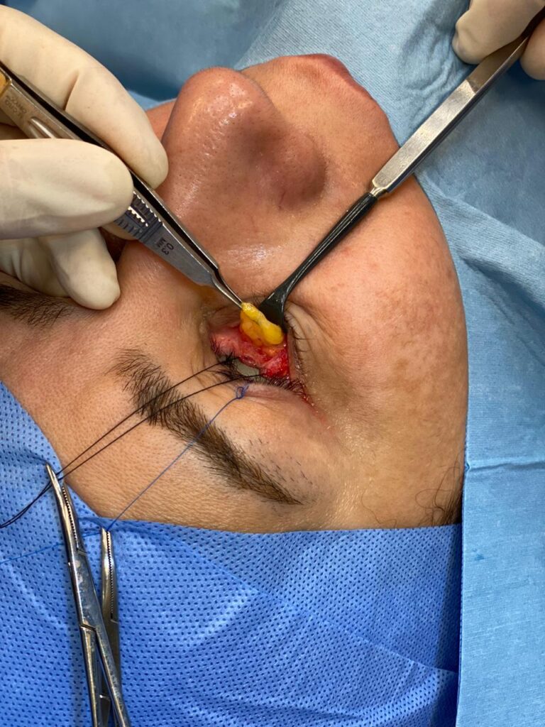 Scarless Lower Eyelid Surgery