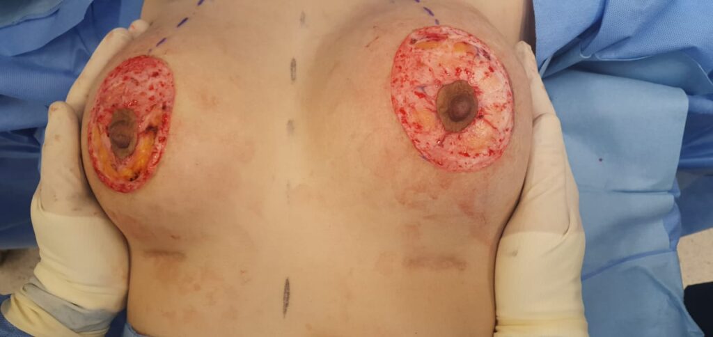 جراحة رفع الثدي في دبي