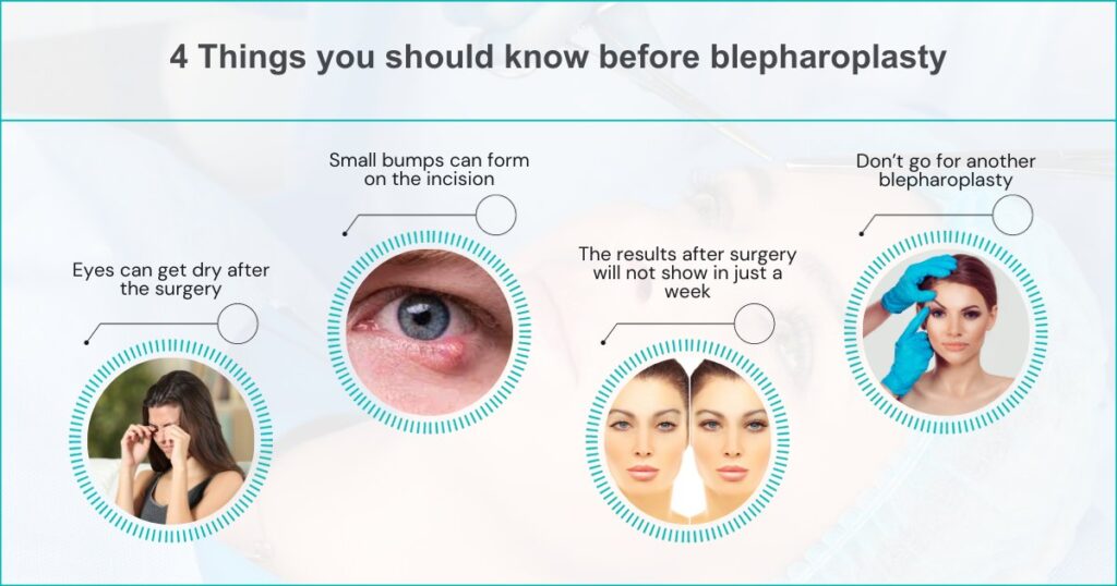 4 Things You Should Know Before Blepharoplasty.jpg