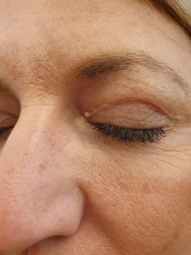 The Occurrence Of Lumps After Blepharoplasty And Techniques To Treat Those Lumps 