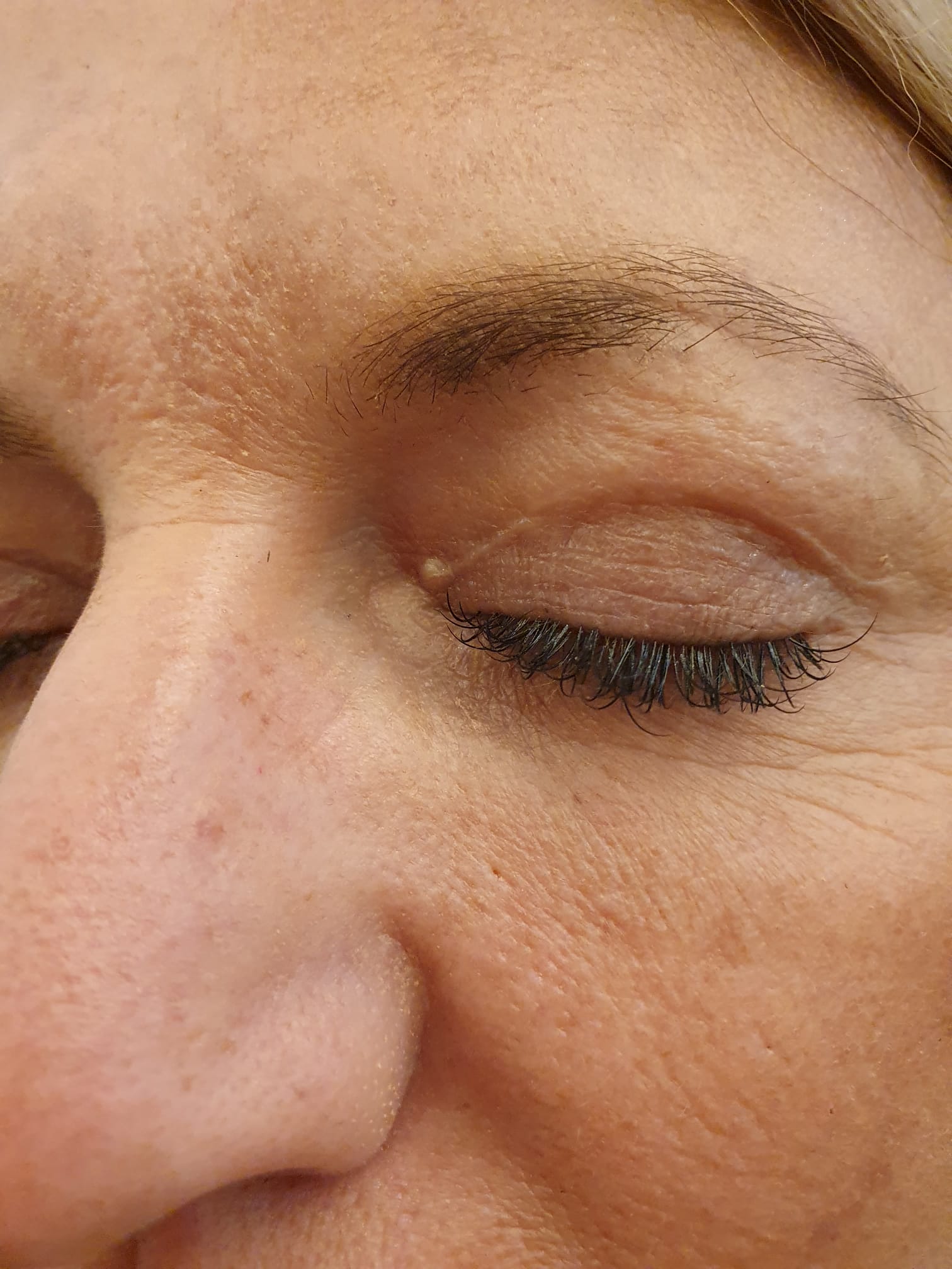 The Occurrence Of Lumps After Blepharoplasty And Techniques To Treat Those Lumps