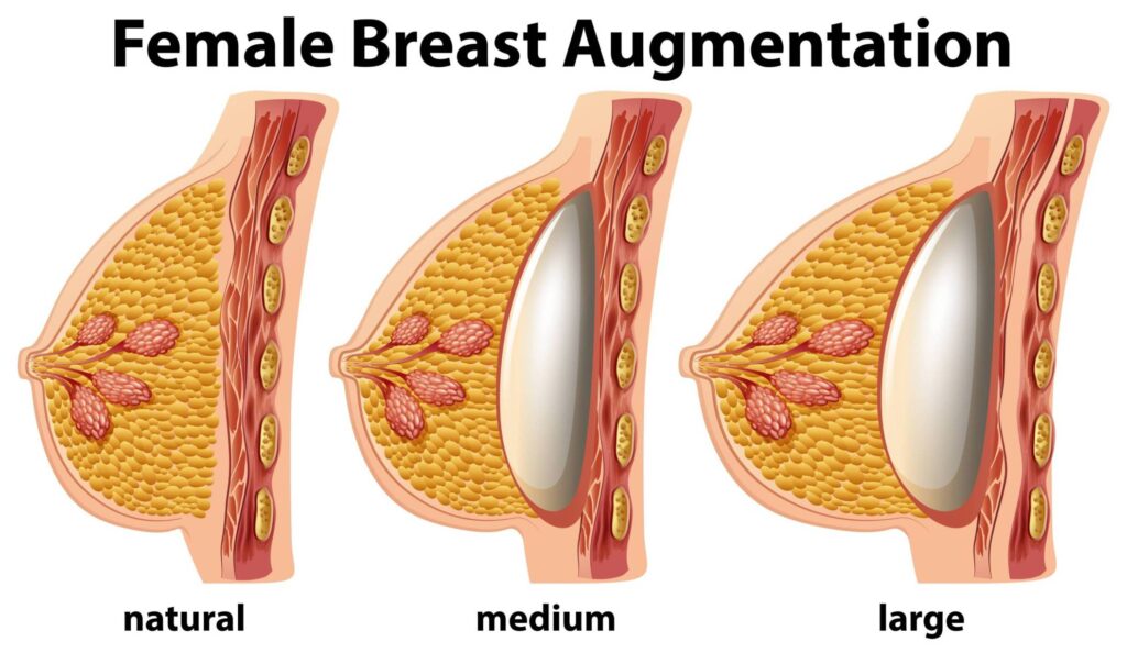 Breast implants placed under the breasts