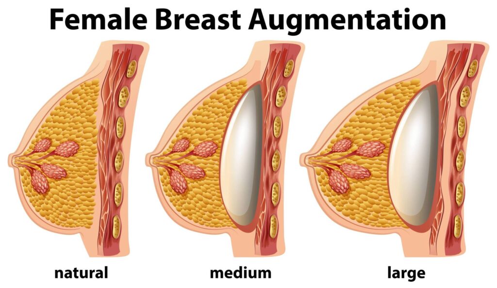 Breast Implants Placed Under The Breasts