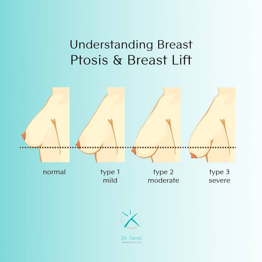 Breast Lift – Mastopexy Surgery