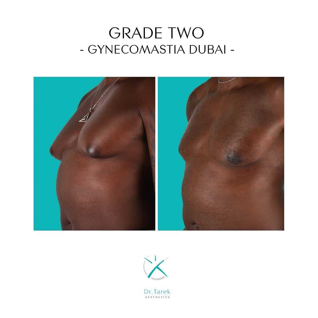Gynecomastia Surgery In Dubai