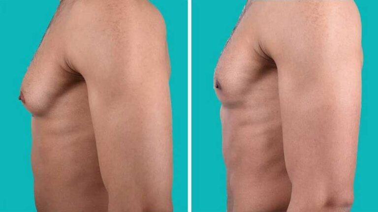 How To Get Rid Of Man Chest With Diet
