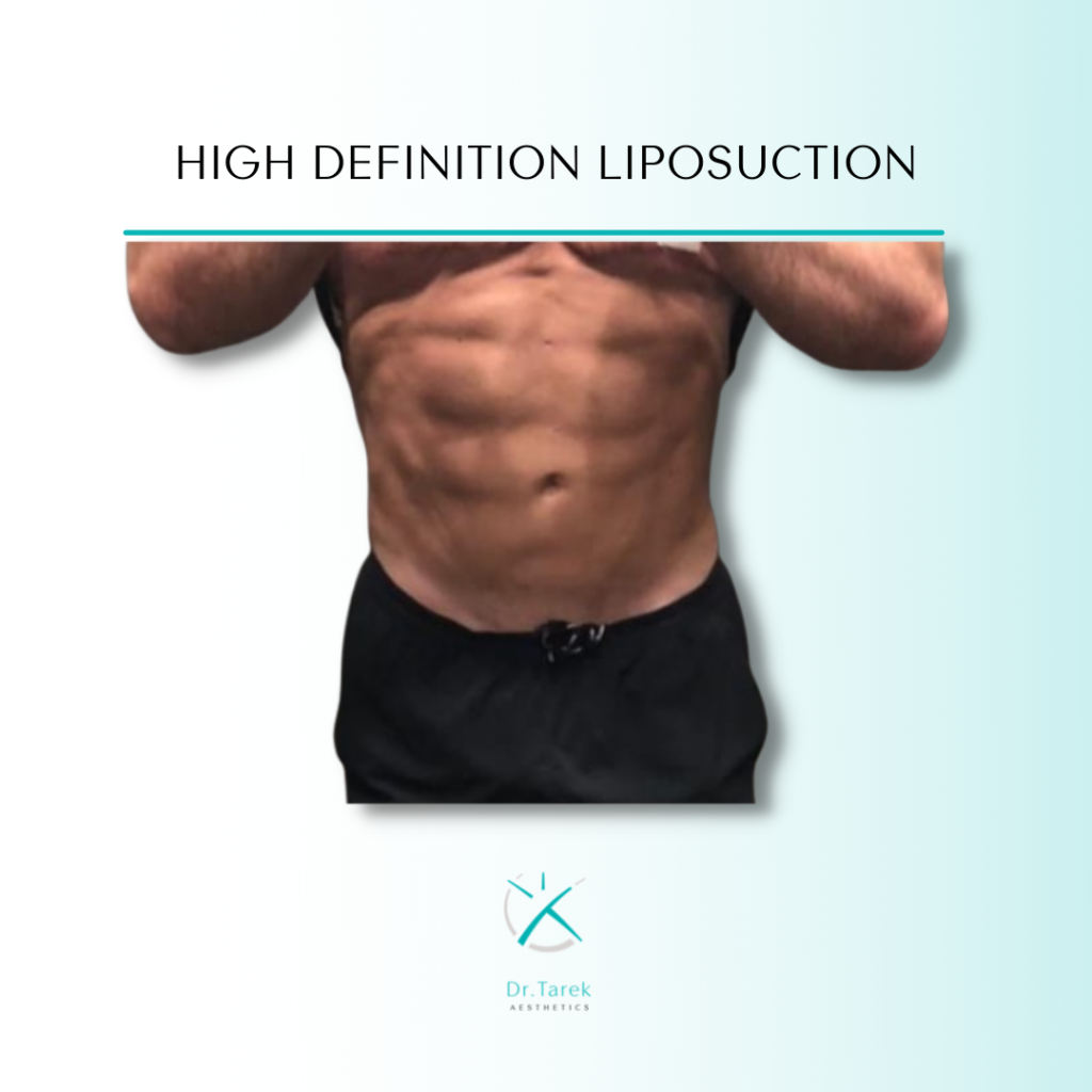 High Definition Liposuction | 6 Pack Liposuction High Definition Liposuction In Dubai