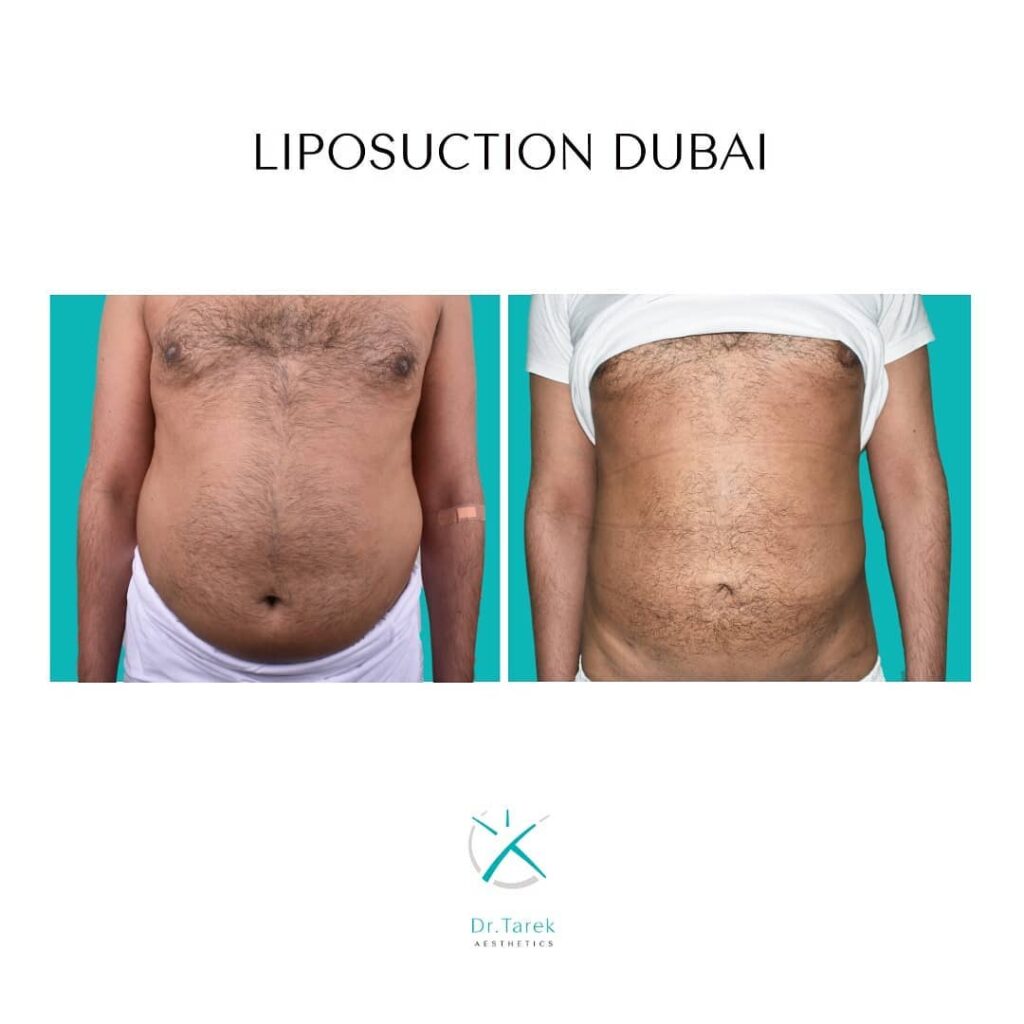 Before And After Of Liposuction