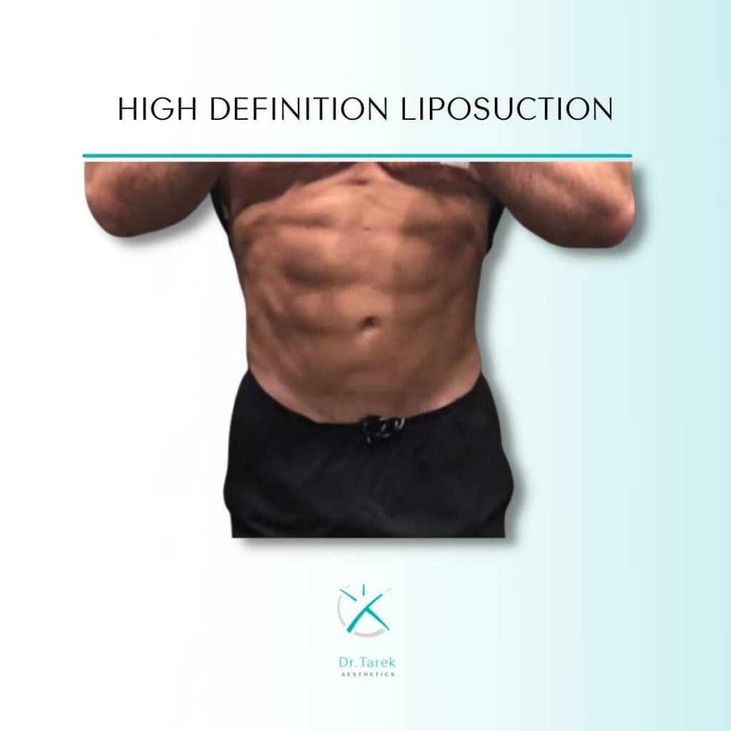 High Defination Liposuction Dubai