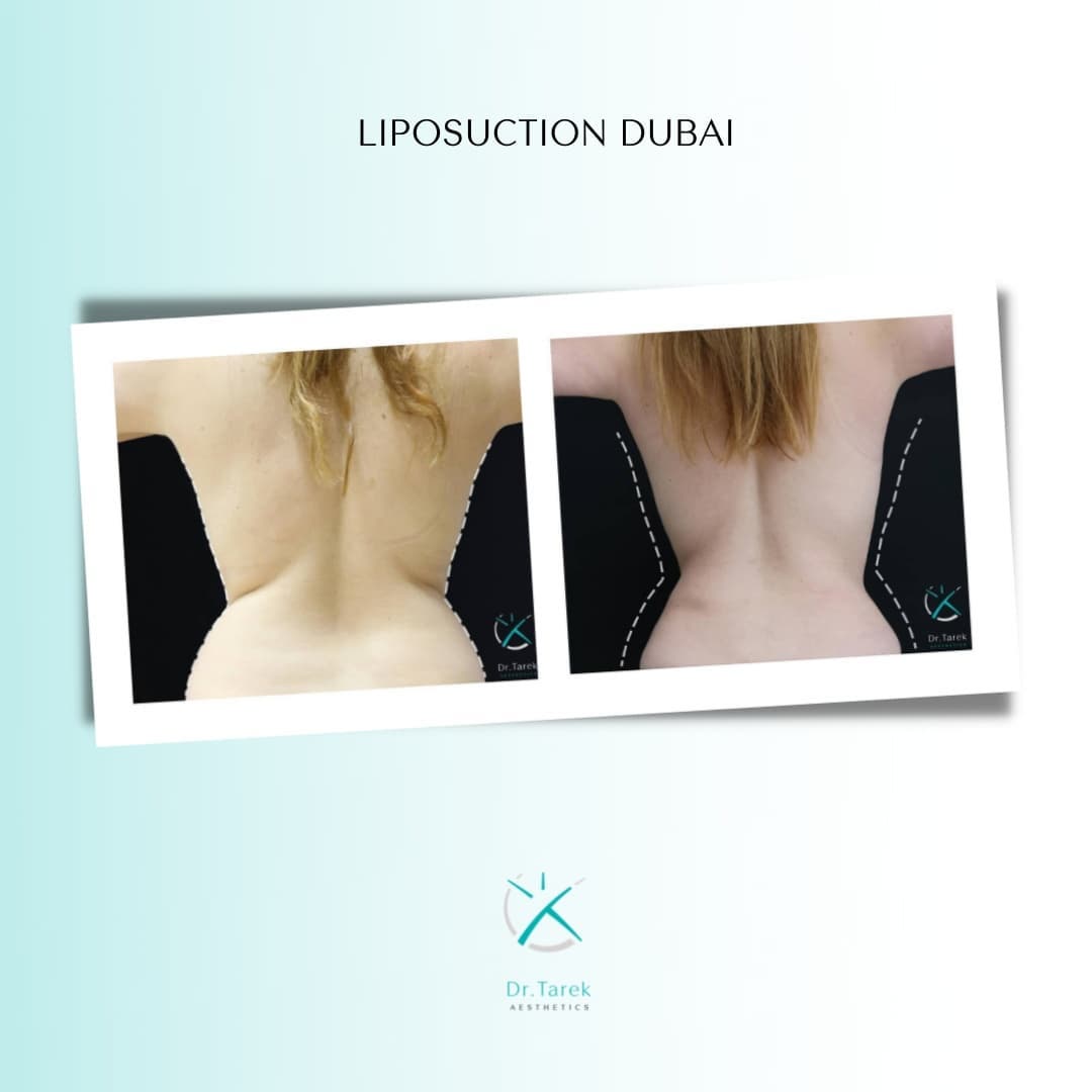 Liposuction Dubai
