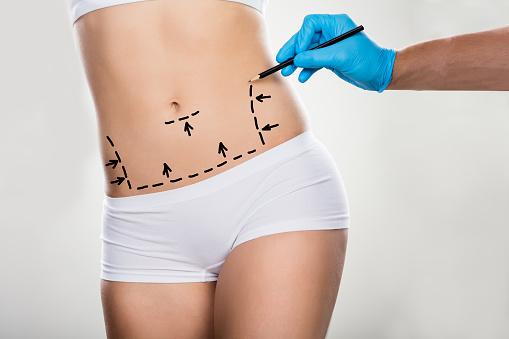 Apronectomy To Remove Loose Tummy Skin