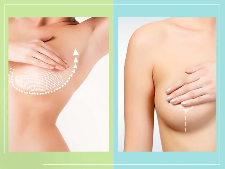 Breast Augmentation Vs. Breast Lift: Which Is The Right Procedure For You?