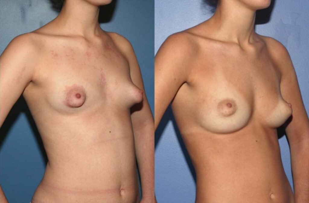 Povećanje Grudi Transferom Masti: Sve Što Treba Da Znate Breast Augmentation
