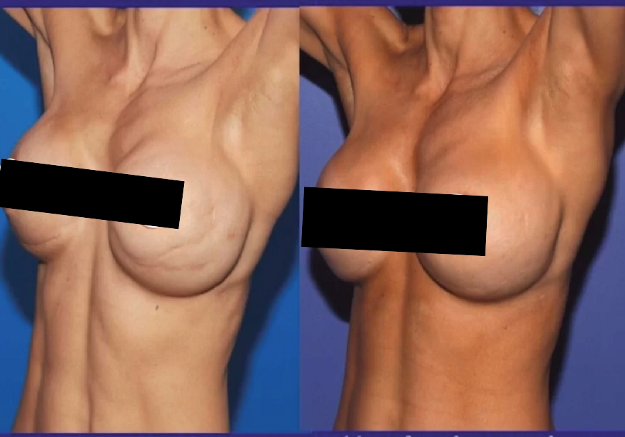 Fat Transfer Breast Augmentation_ All You Need To Know
