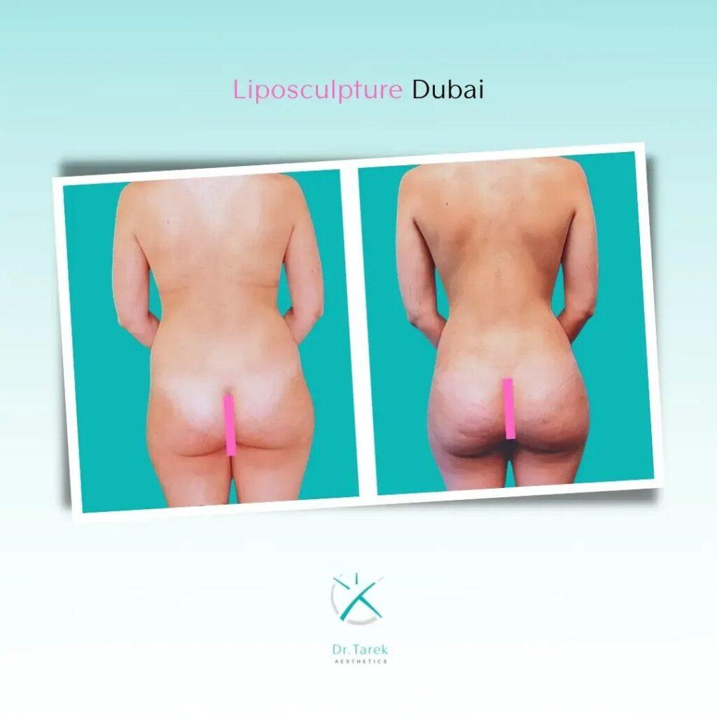 Liposuction In Dubai