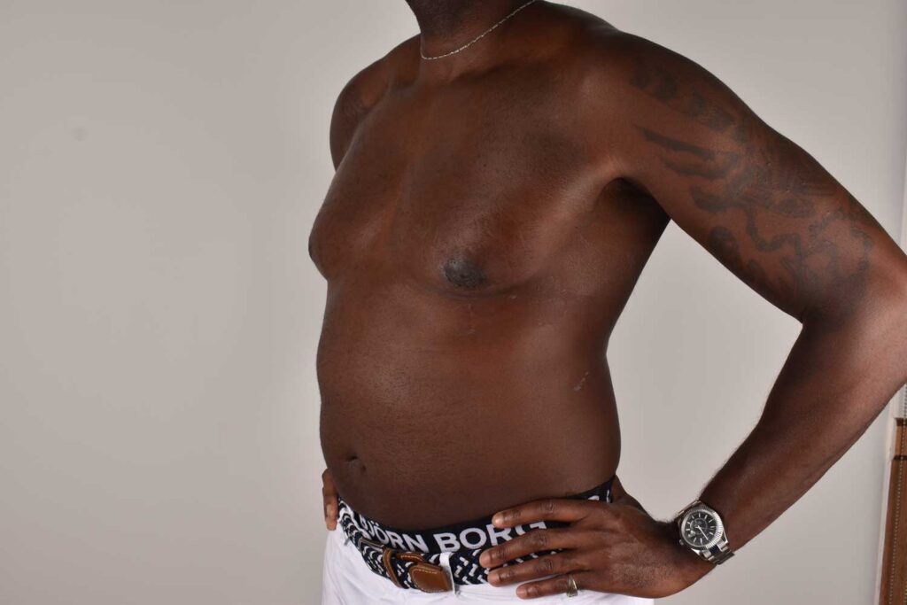 Male Body Contouring