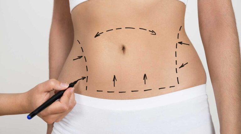 What Type Of Tummy Tuck Is Best For You?