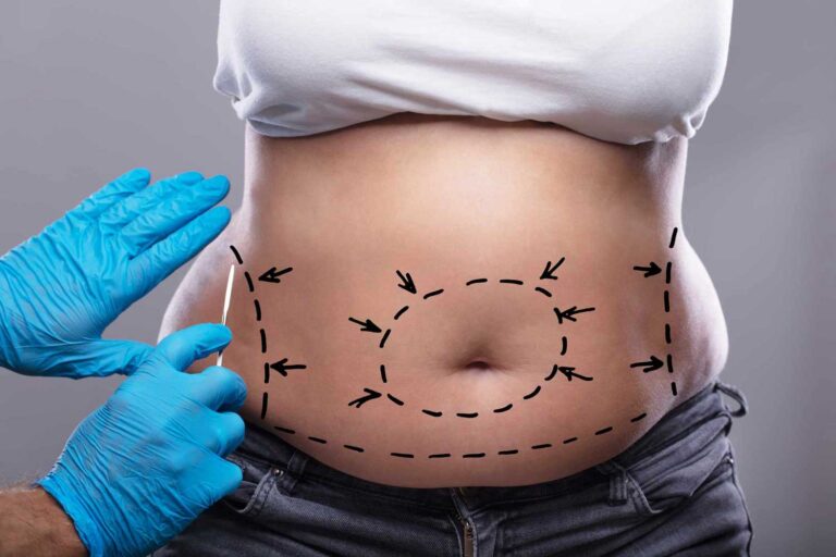 Factors To Keep In Mind Before Getting A Tummy Tuck