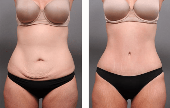 The Recovery Process After Tummy Tuck