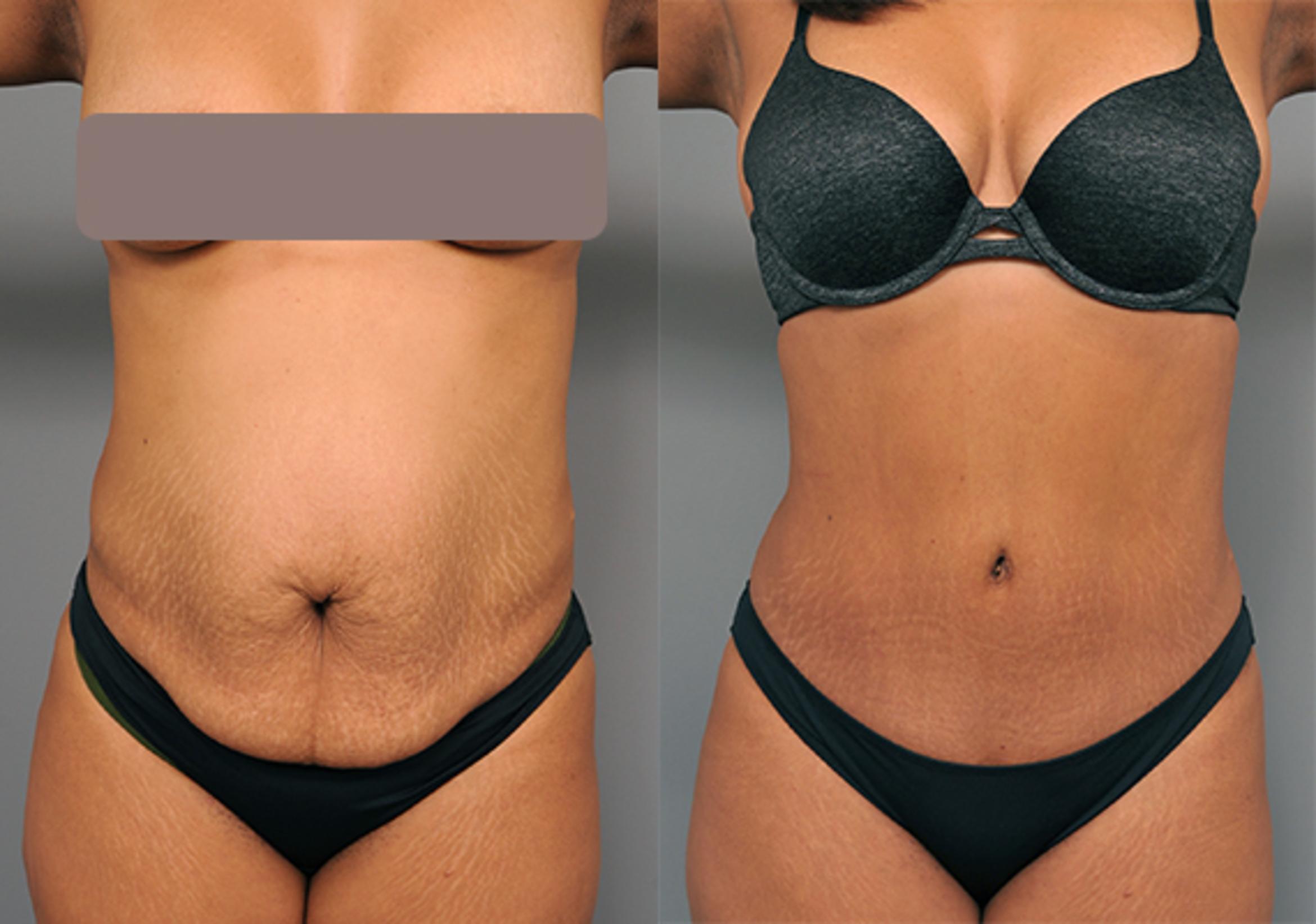 Tummy Tuck In Dubai