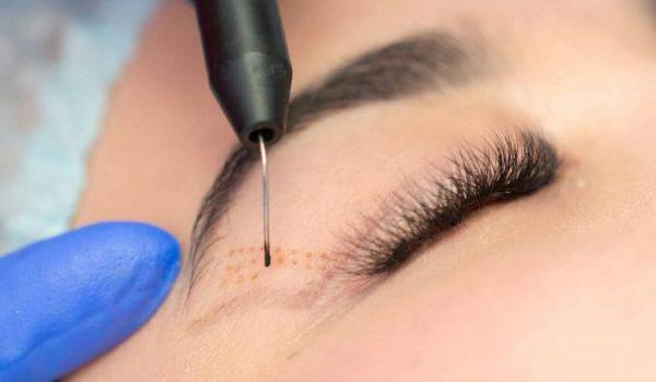 Eyelid Surgery With Laser