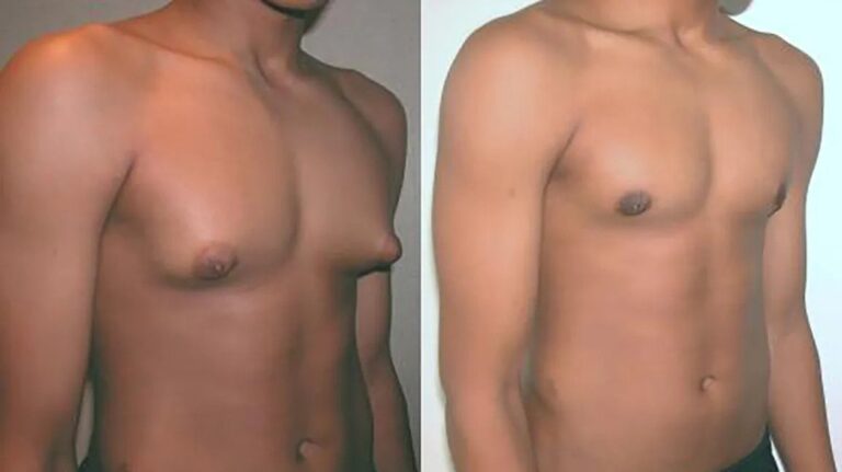 Gynecomastia: What Is Causing Your Man Chest?