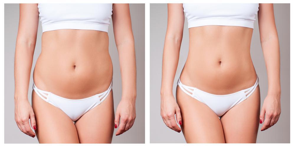 Tummy Tuck Vs Liposuction