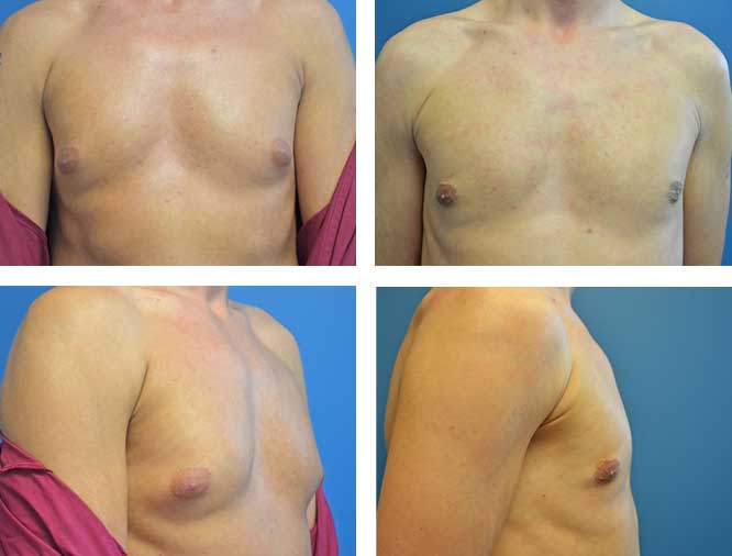 Gynecomastia Surgery In Dubai: The Recovery Process