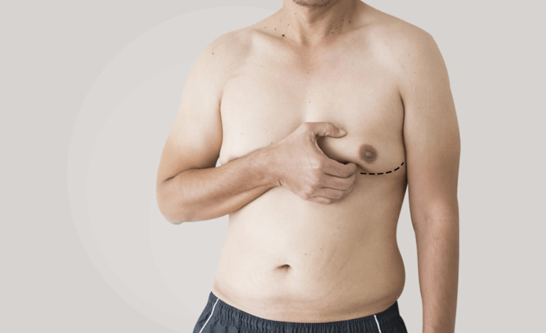 What Is Gynecomastia? How Does It Affect Men And Boys?