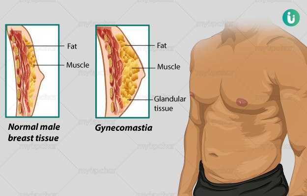 Male Breast Enlargement (Gynecomastia) Symptoms