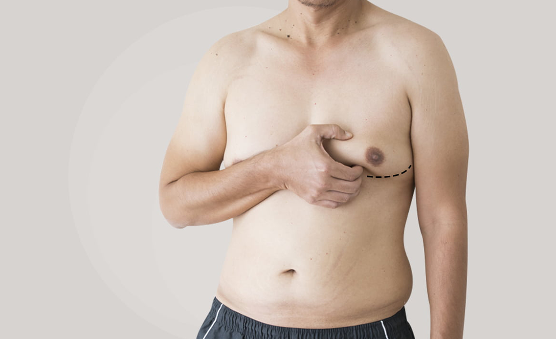What Is Gynecomastia? How Does It Affect Men And Boys? 2024