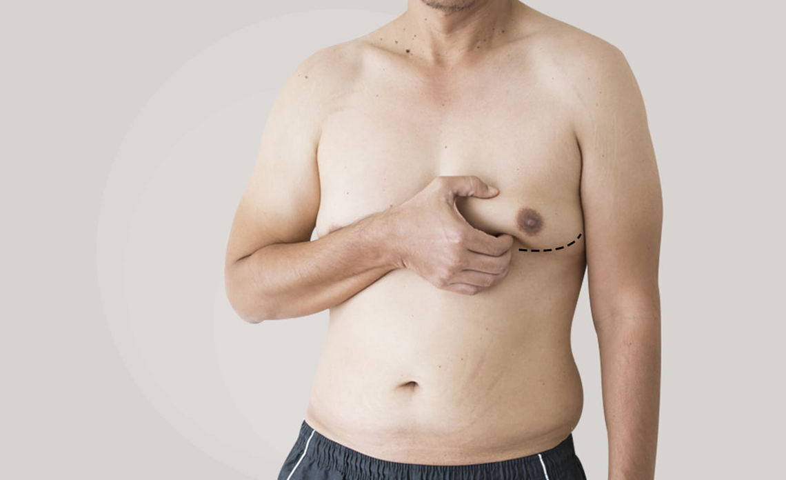 Male breast lift surgery reverses changes after large weight loss, Health