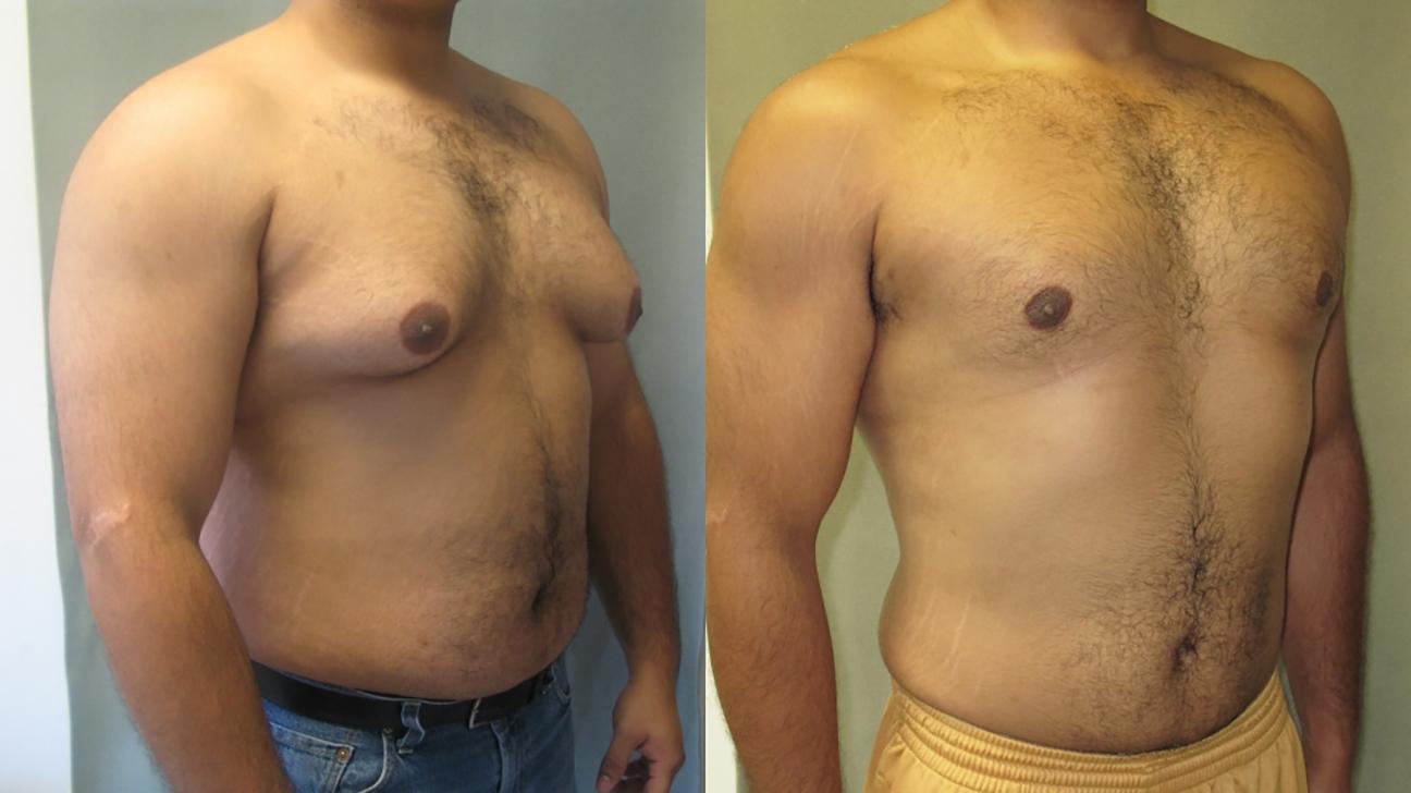 Gynecomastia Surgery In Dubai