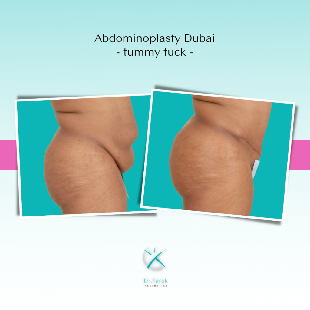 Tummy Tuck In Dubai