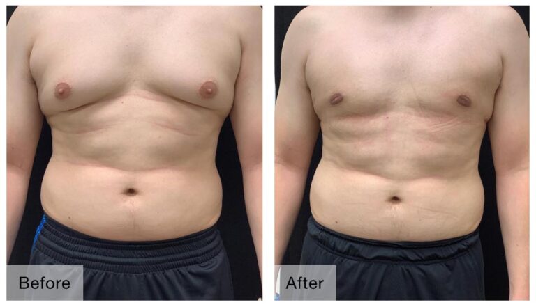 Men’S Breast Reduction Surgery | Liposuction For Man Chests