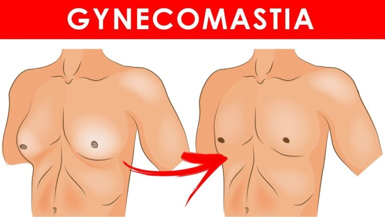 Gynecomastia Natural Remedies
