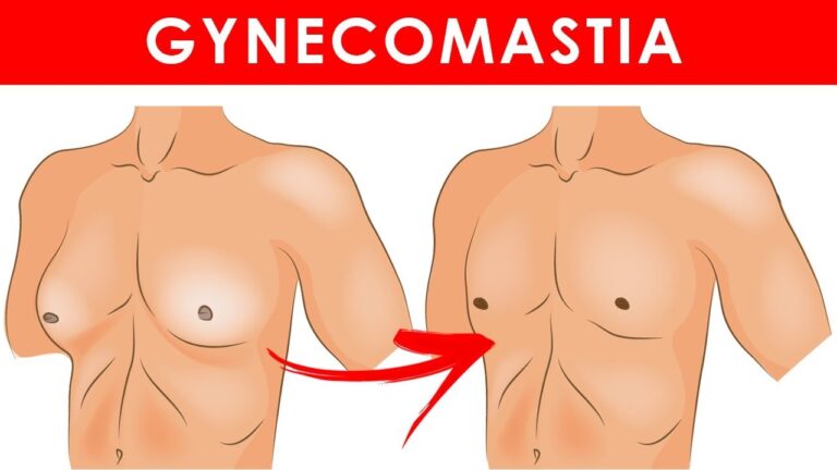 Prirodne Metode Za Ginekomastiju