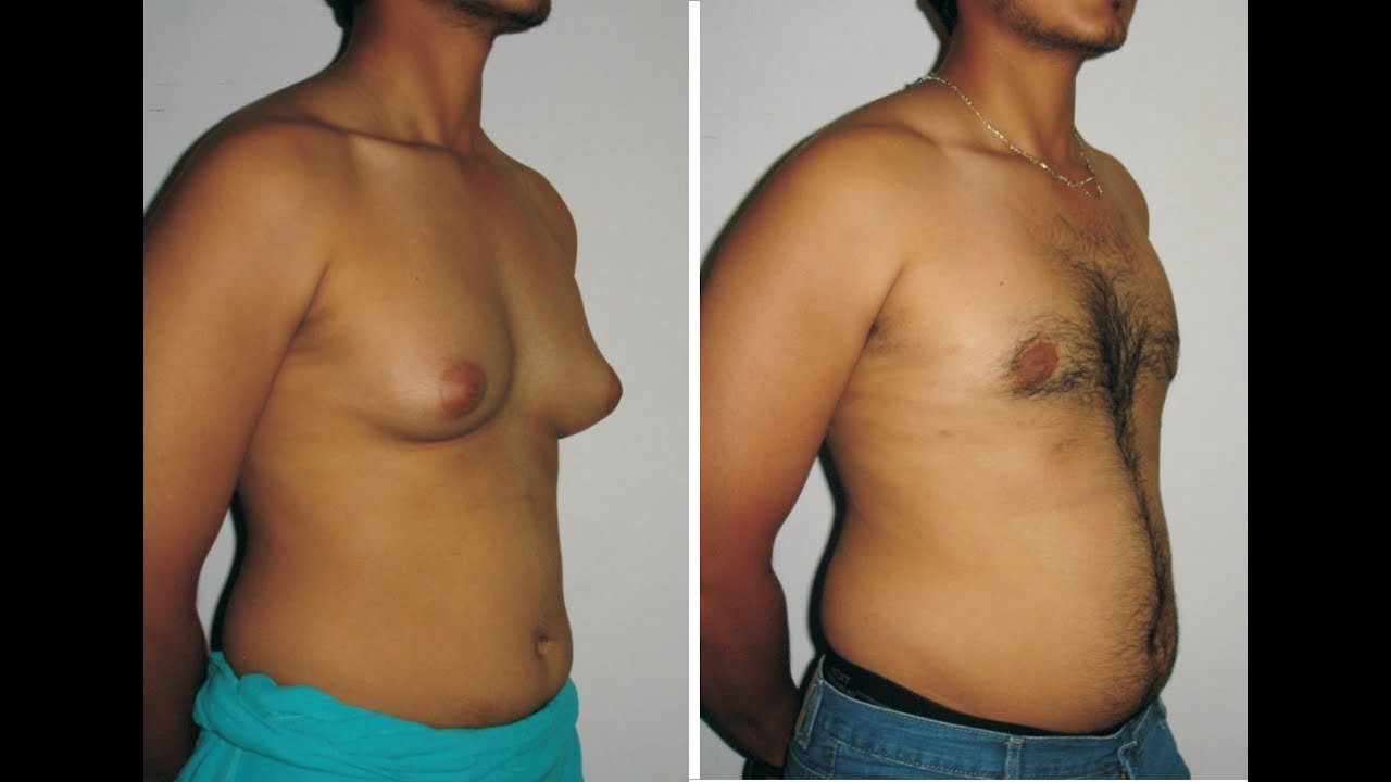 Gynecomastia Post-Surgery Swelling