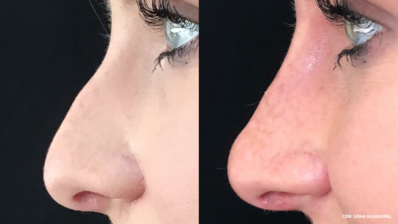 Rhinoplasty Dubai