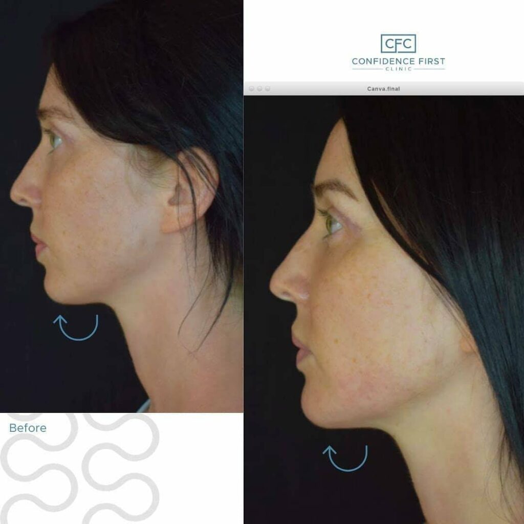 Dermal Fillers Before And After