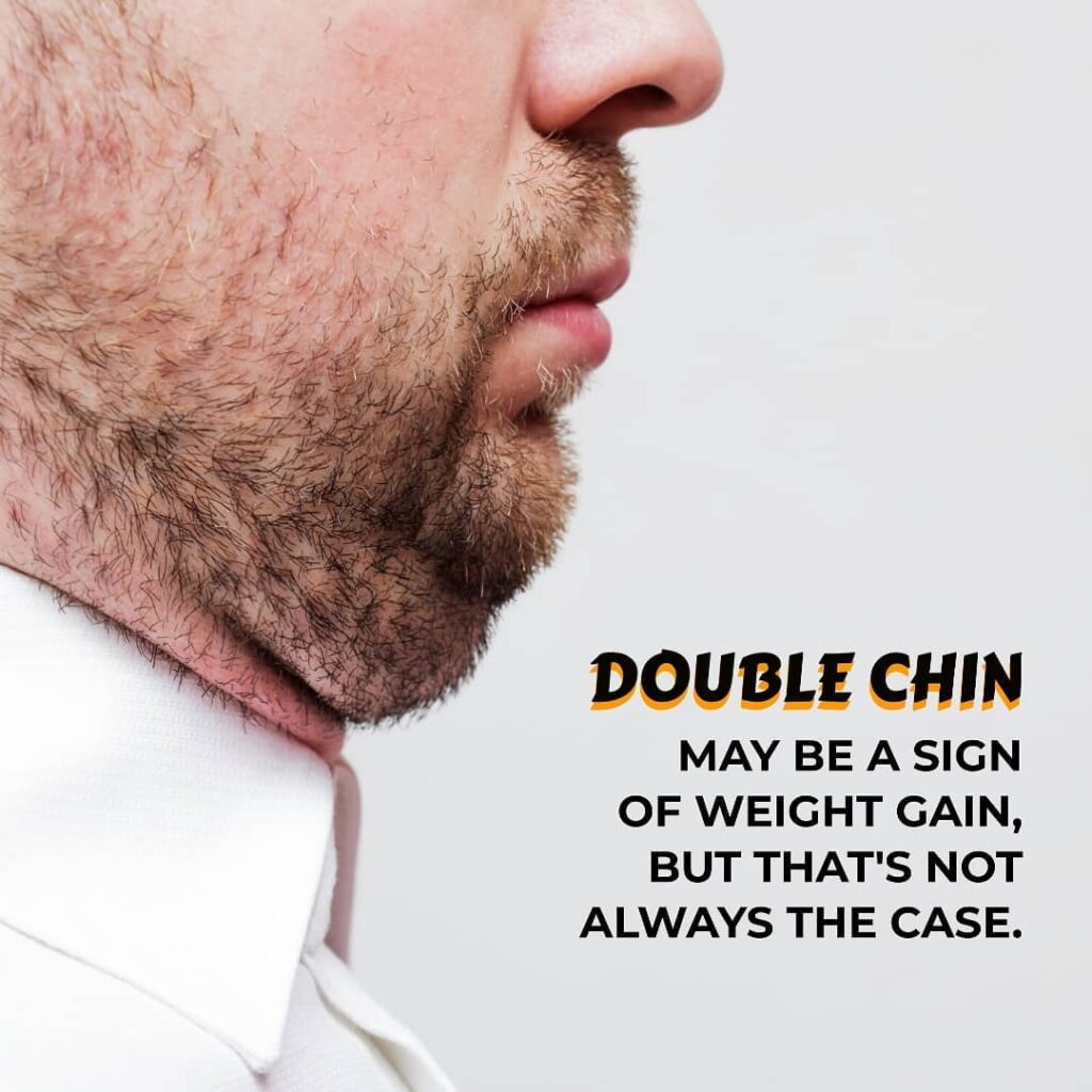 Double Chin Liposuction In Dubai