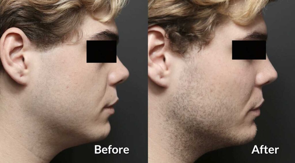 Dermal Fillers Before And After