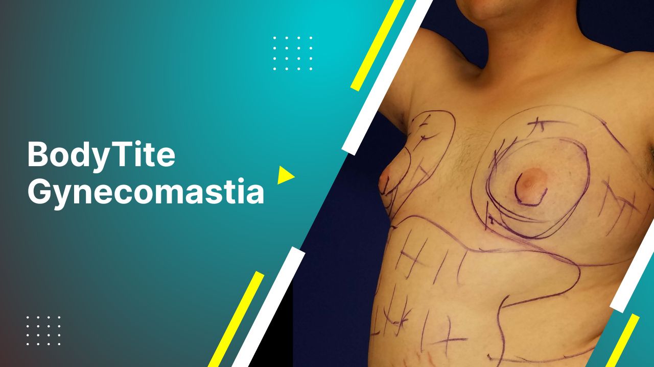 Bodytite Gynecomastia