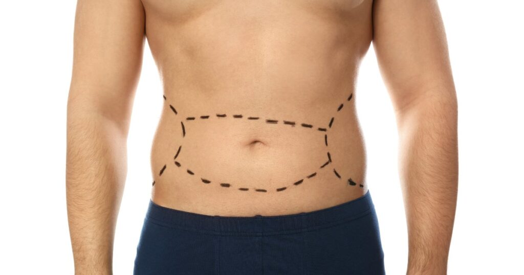 How Long Do Mini Tummy Tuck Results Last