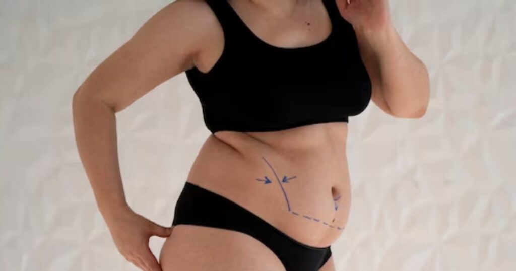 Is A Mini Tummy Tuck Worth It