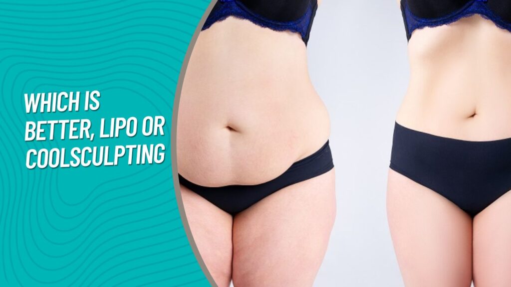 Liposuction Vs. CoolSculpting Which Is Better, Lipo Or CoolSculpting 2024