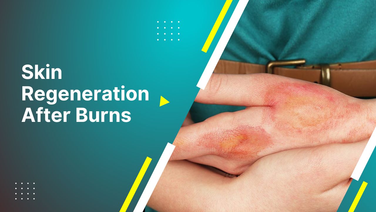 Skin Regeneration After Burns Skin Healing After Burns
