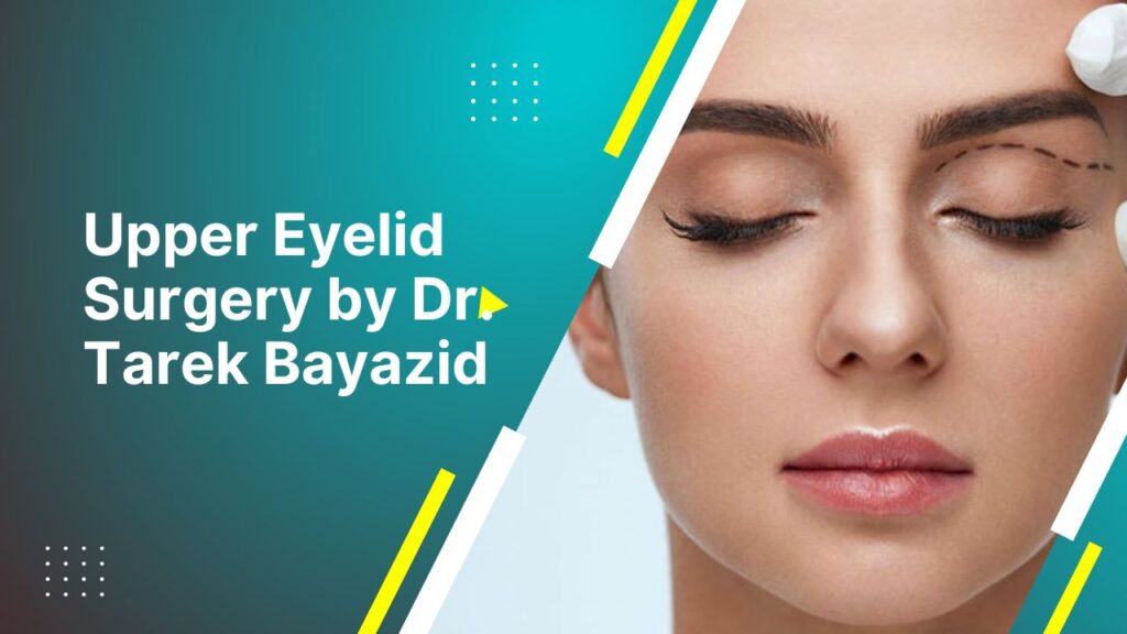 Upper Eyelid Surgery By Dr. Tarek Bayazid 2024