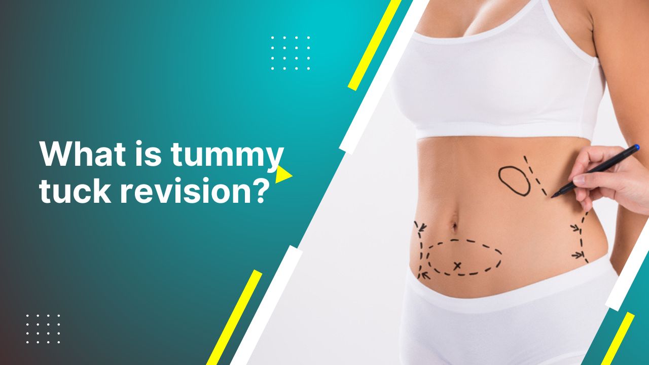 What Is Tummy Tuck Revision?  Are Tummy Tuck Revision Free 2024