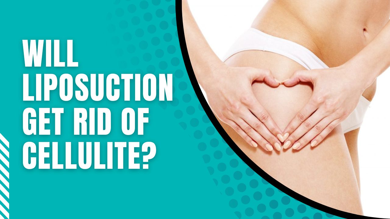 Will Liposuction Get Rid Of Cellulite Will Liposuction Help Cellulite